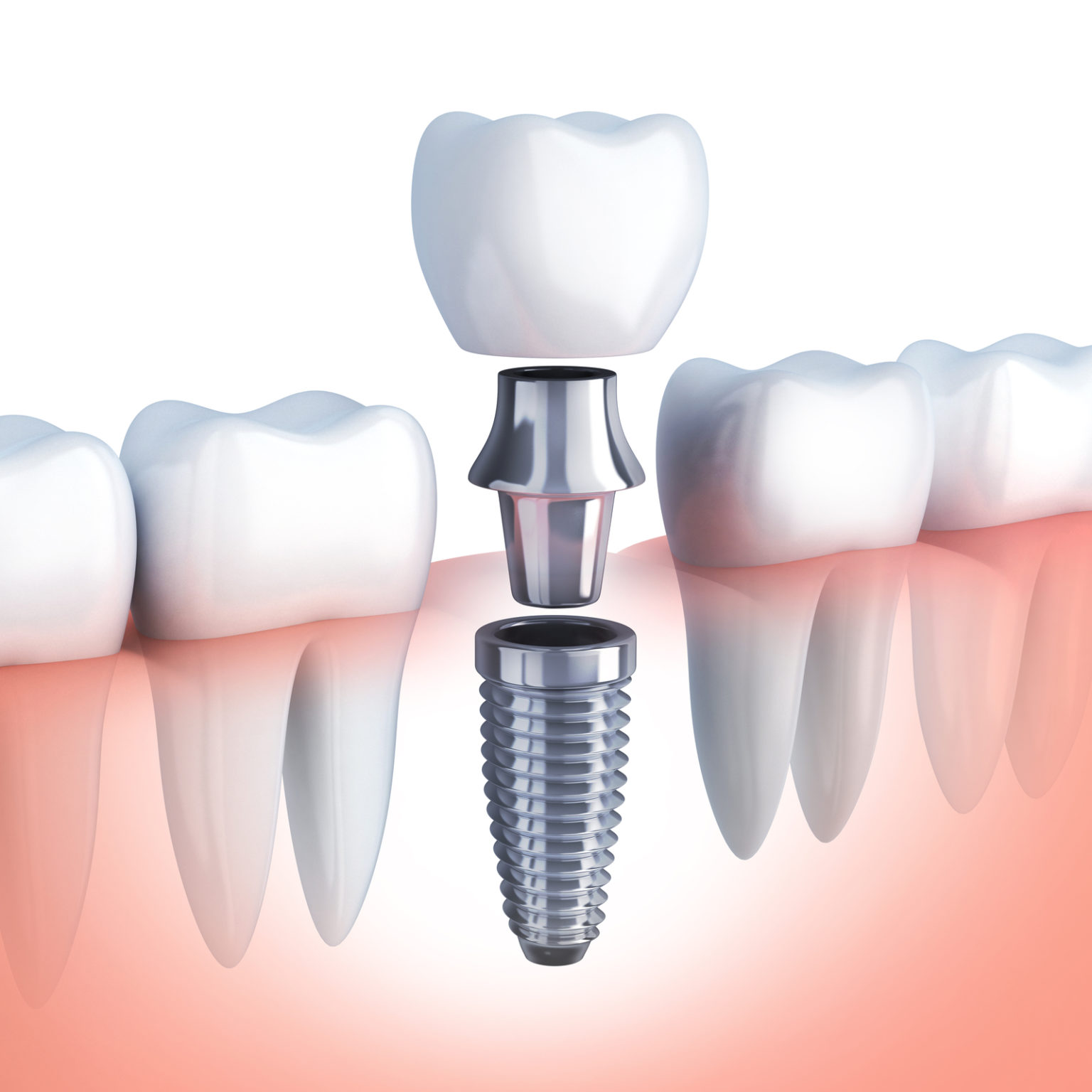 Dental Implants Forest Acres Dentistry, Columbia SC